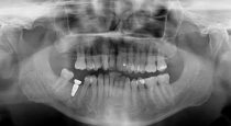 Implant — A Dental Story — Part 2